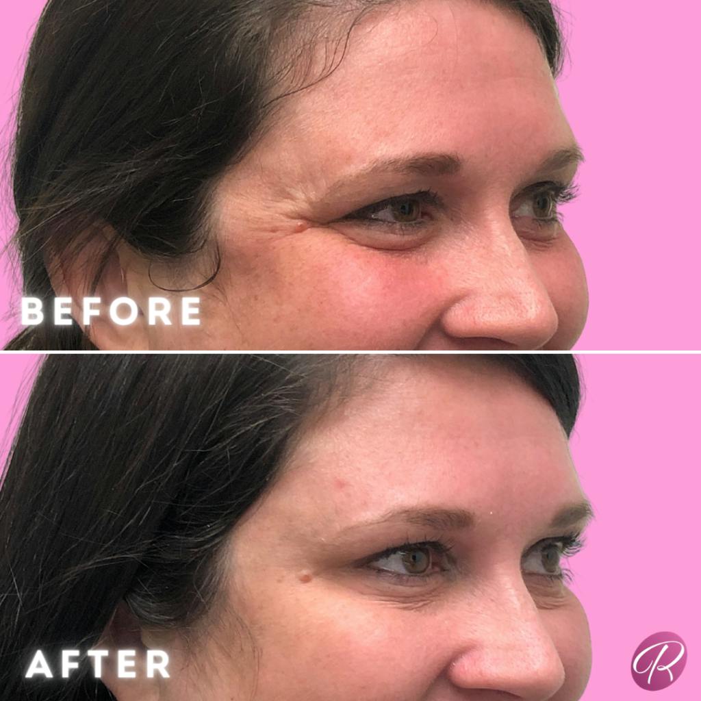 BOTOX Cosmetic Before & After Gallery - Patient 86641208 - Image 2