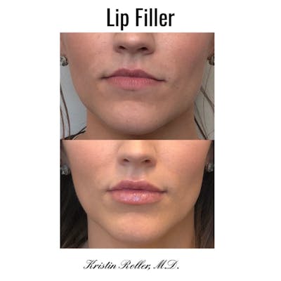 Fillers Before & After Gallery - Patient 86641212 - Image 1