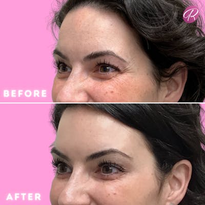 BOTOX Cosmetic Before & After Gallery - Patient 86641217 - Image 1
