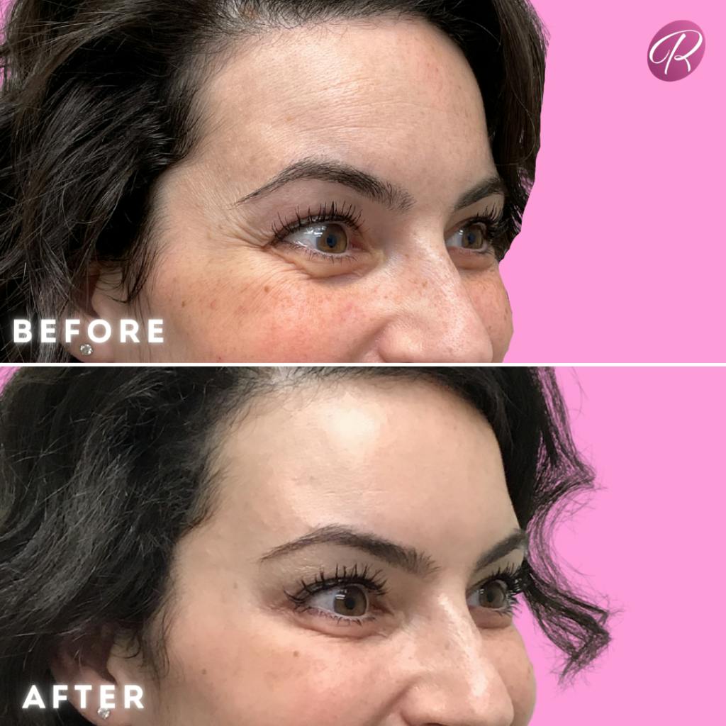 BOTOX Cosmetic Before & After Gallery - Patient 86641217 - Image 2