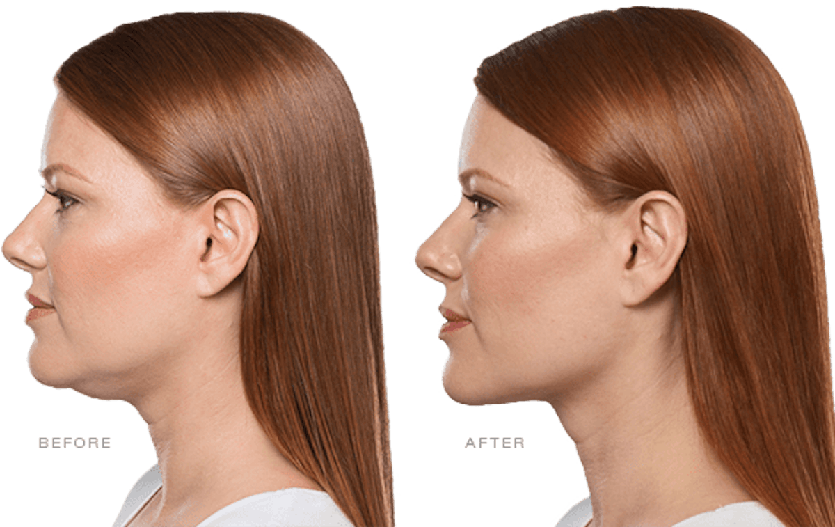 KYBELLA Before & After Gallery - Patient 86641226 - Image 1