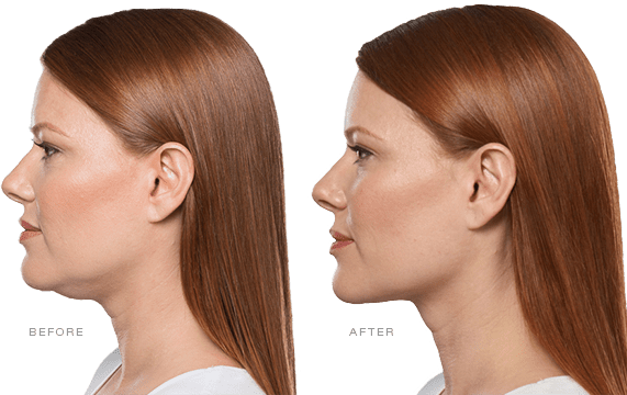 KYBELLA Before & After Gallery - Patient 86641226 - Image 1