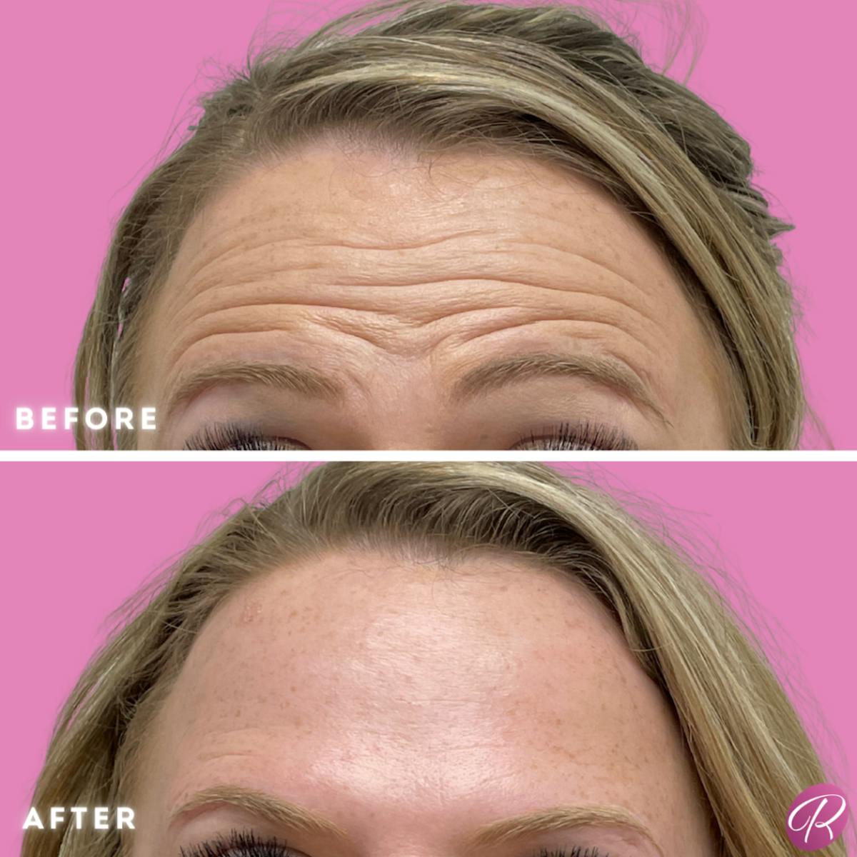 BOTOX Cosmetic Before & After Gallery - Patient 86641227 - Image 2
