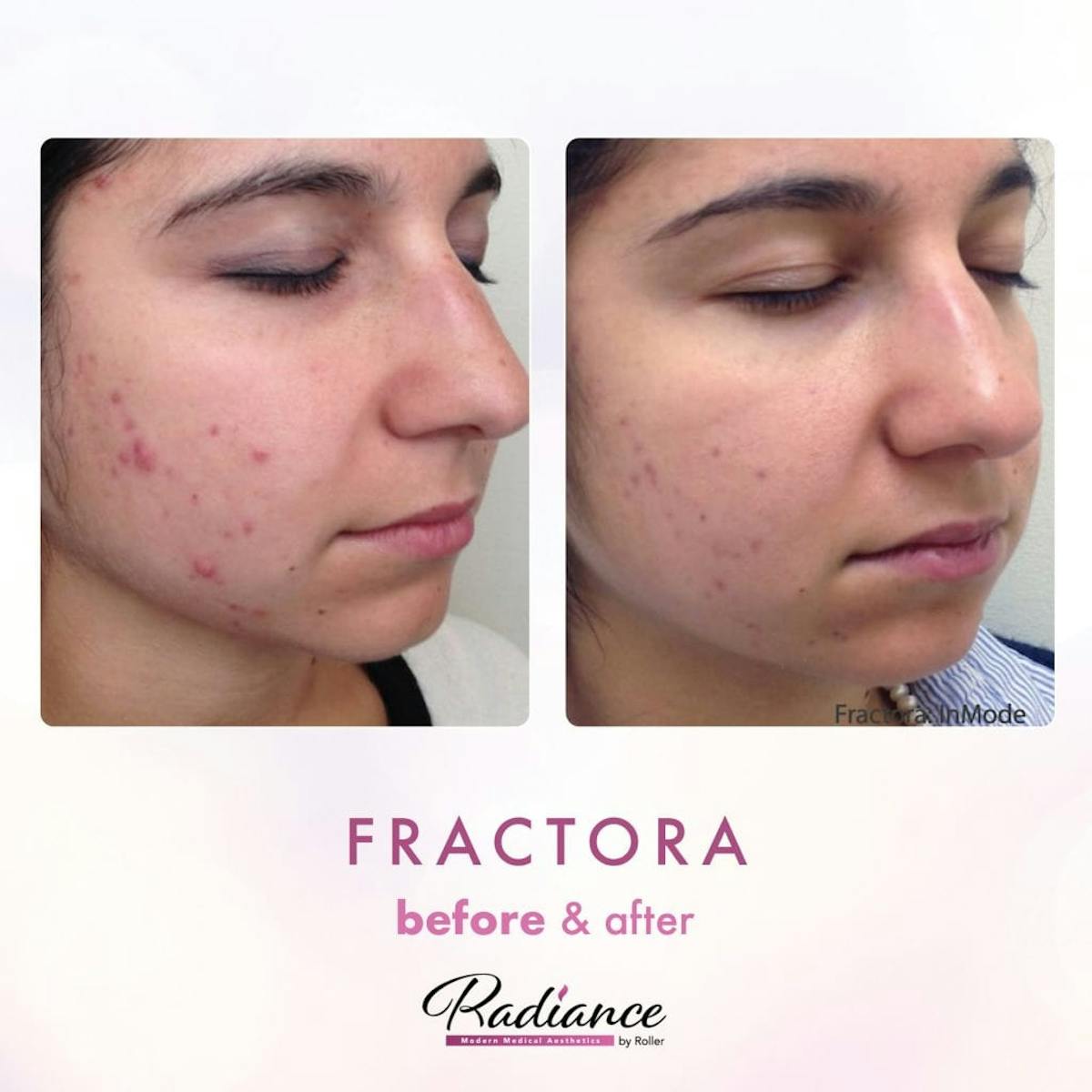 Fractora Before & After Gallery - Patient 86641228 - Image 1