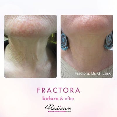 Fractora Before & After Gallery - Patient 86641231 - Image 1