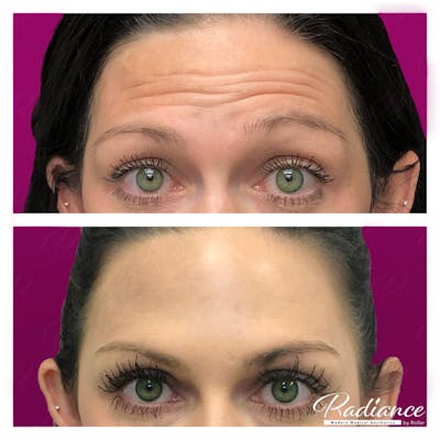 BOTOX Cosmetic Before & After Gallery - Patient 86641233 - Image 1