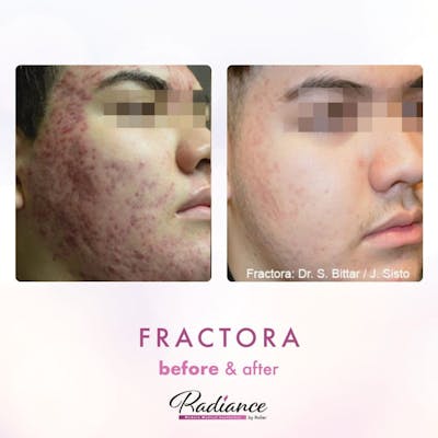 Fractora Before & After Gallery - Patient 86641232 - Image 1