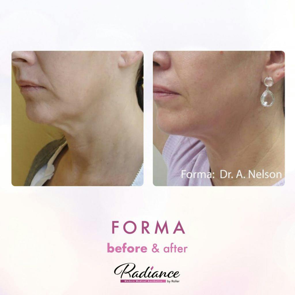 Forma Before & After Gallery - Patient 86641234 - Image 1