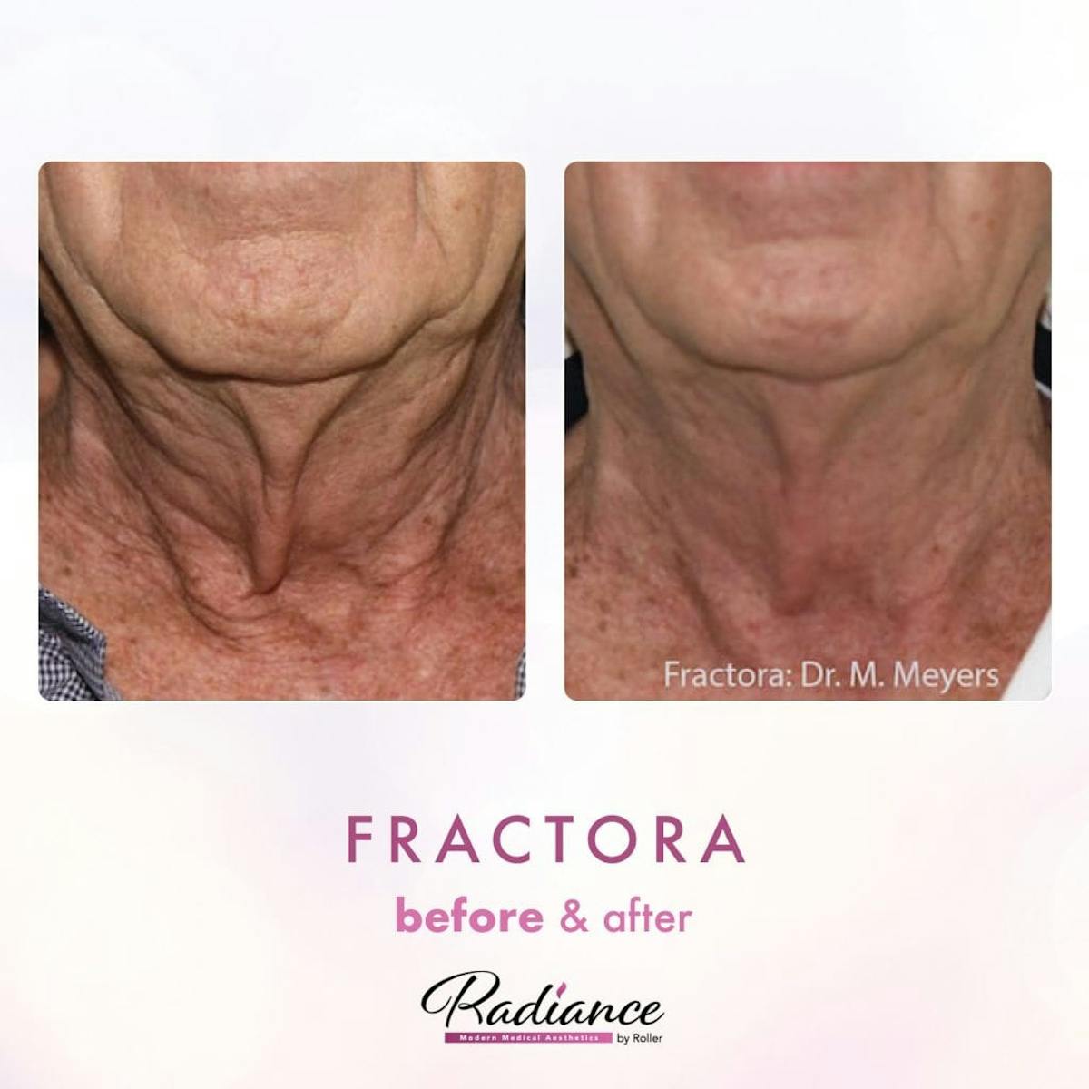 Fractora Before & After Gallery - Patient 86641235 - Image 1