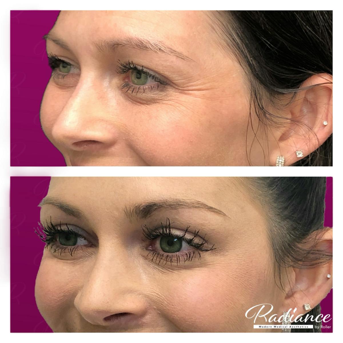 BOTOX Cosmetic Before & After Gallery - Patient 86641240 - Image 1