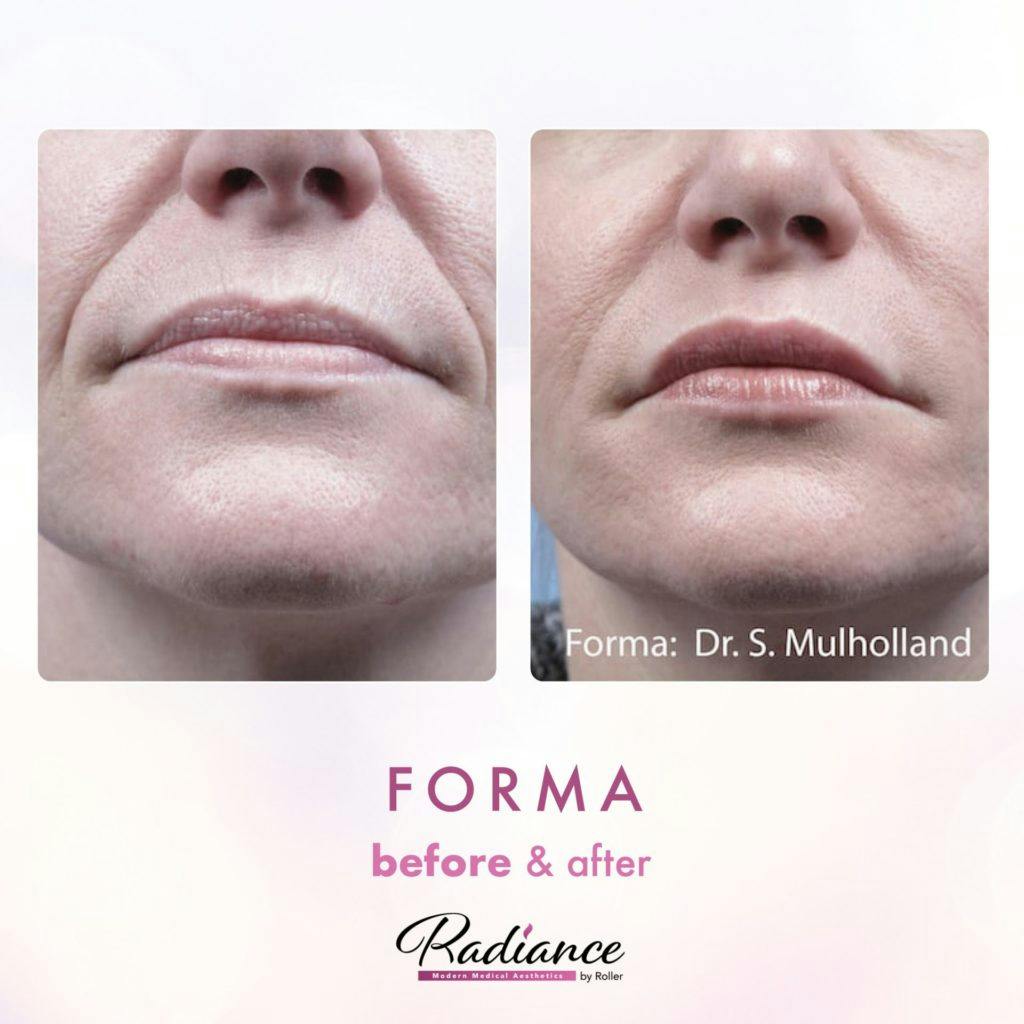 Forma Before & After Gallery - Patient 86641236 - Image 1