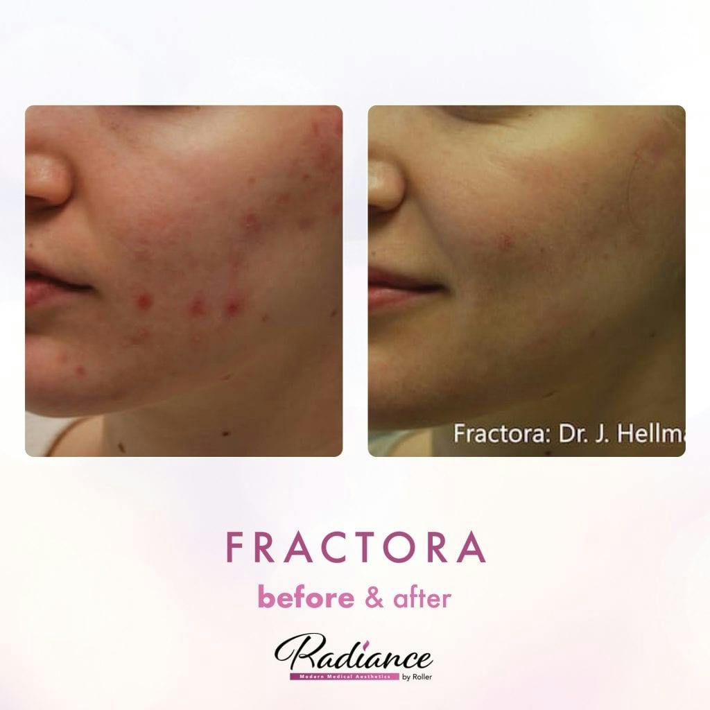 Fractora Before & After Gallery - Patient 86641237 - Image 1