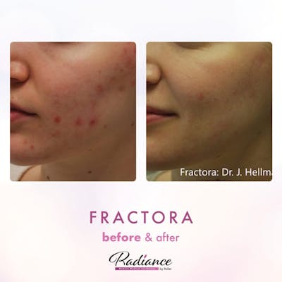 Fractora Before & After Gallery - Patient 86641237 - Image 1