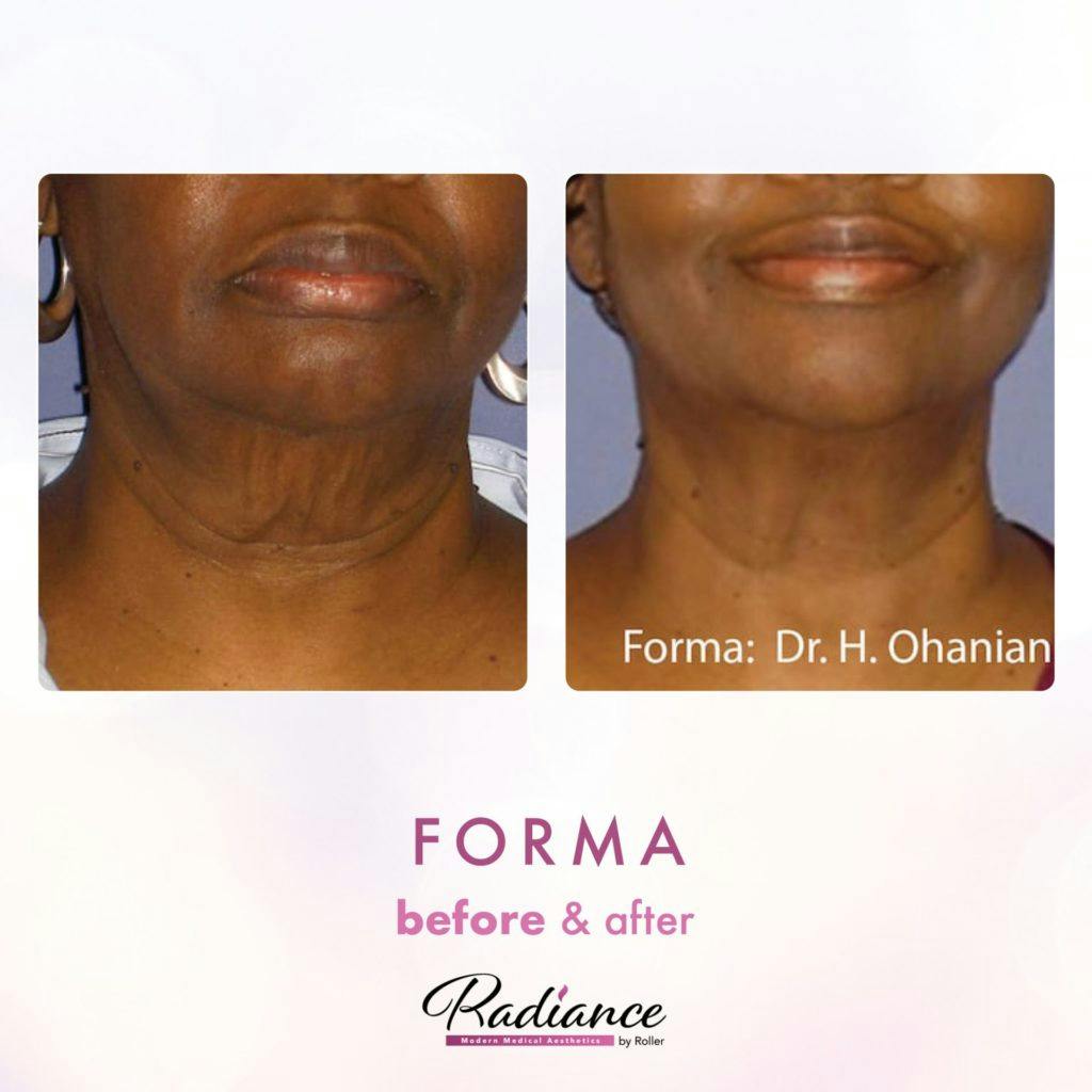 Forma Before & After Gallery - Patient 86641241 - Image 1