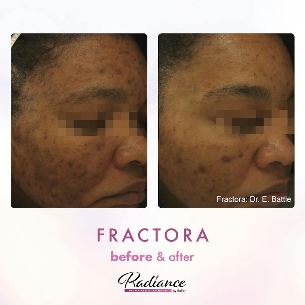 Fractora Before & After Gallery - Patient 86641242 - Image 1