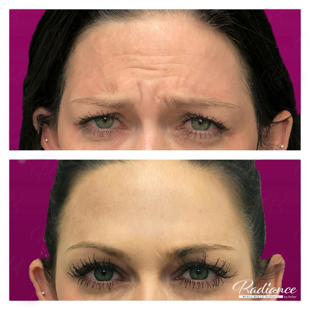 BOTOX Cosmetic Before & After Gallery - Patient 86641245 - Image 1