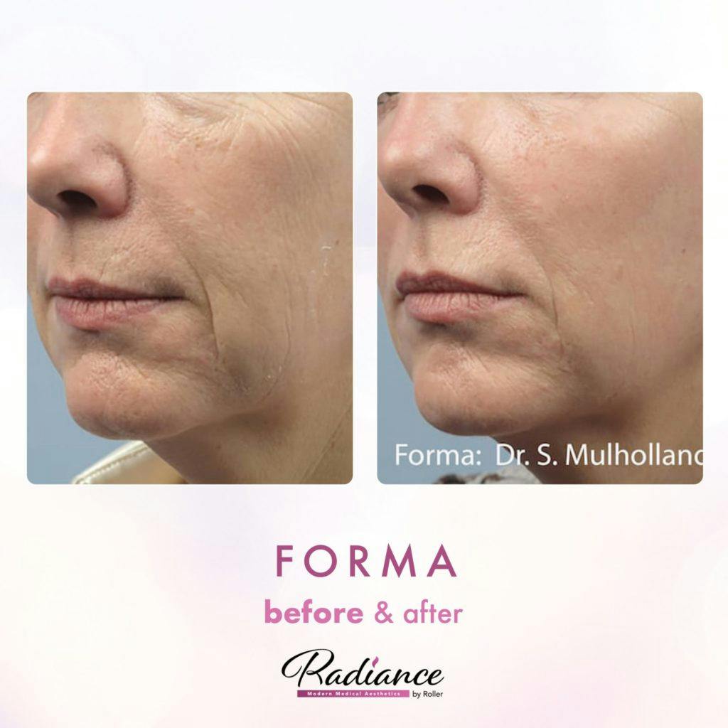 Forma Before & After Gallery - Patient 86641243 - Image 1