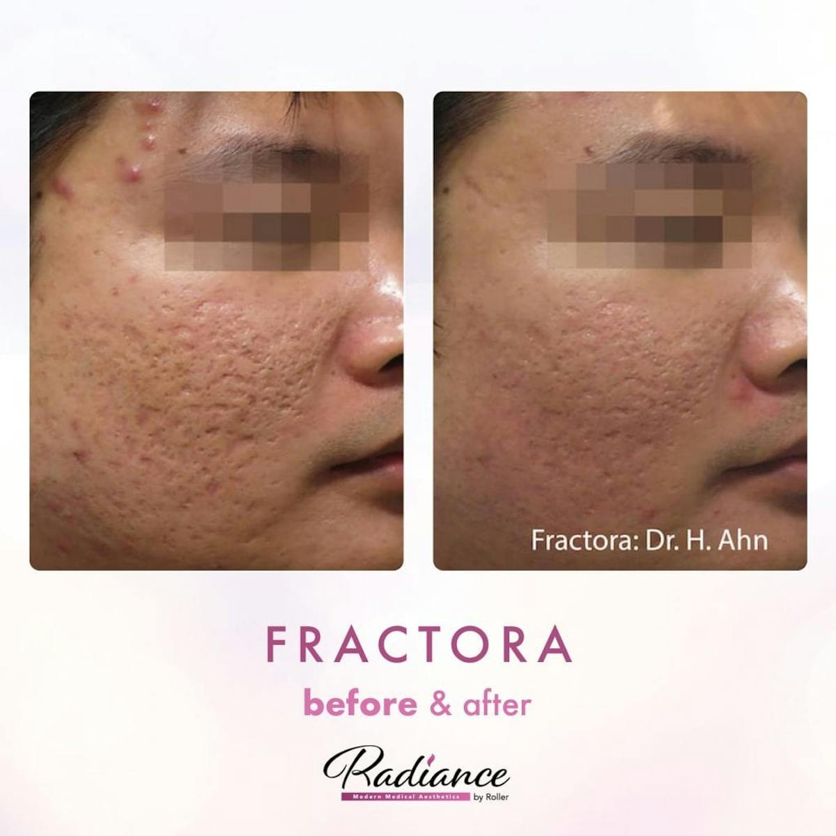 Fractora Before & After Gallery - Patient 86641244 - Image 1
