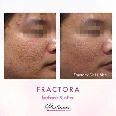 Fractora Before & After Gallery - Patient 86641244 - Image 1