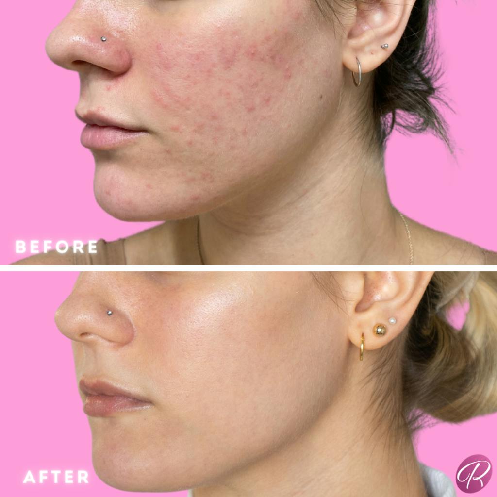 SkinPen Before & After Gallery - Patient 86641247 - Image 1