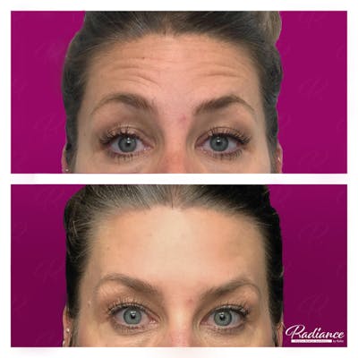 BOTOX Cosmetic Before & After Gallery - Patient 86641249 - Image 1