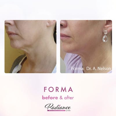Forma Before & After Gallery - Patient 86641250 - Image 1