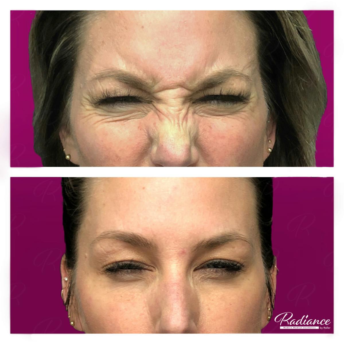 BOTOX Cosmetic Before & After Gallery - Patient 86641249 - Image 2