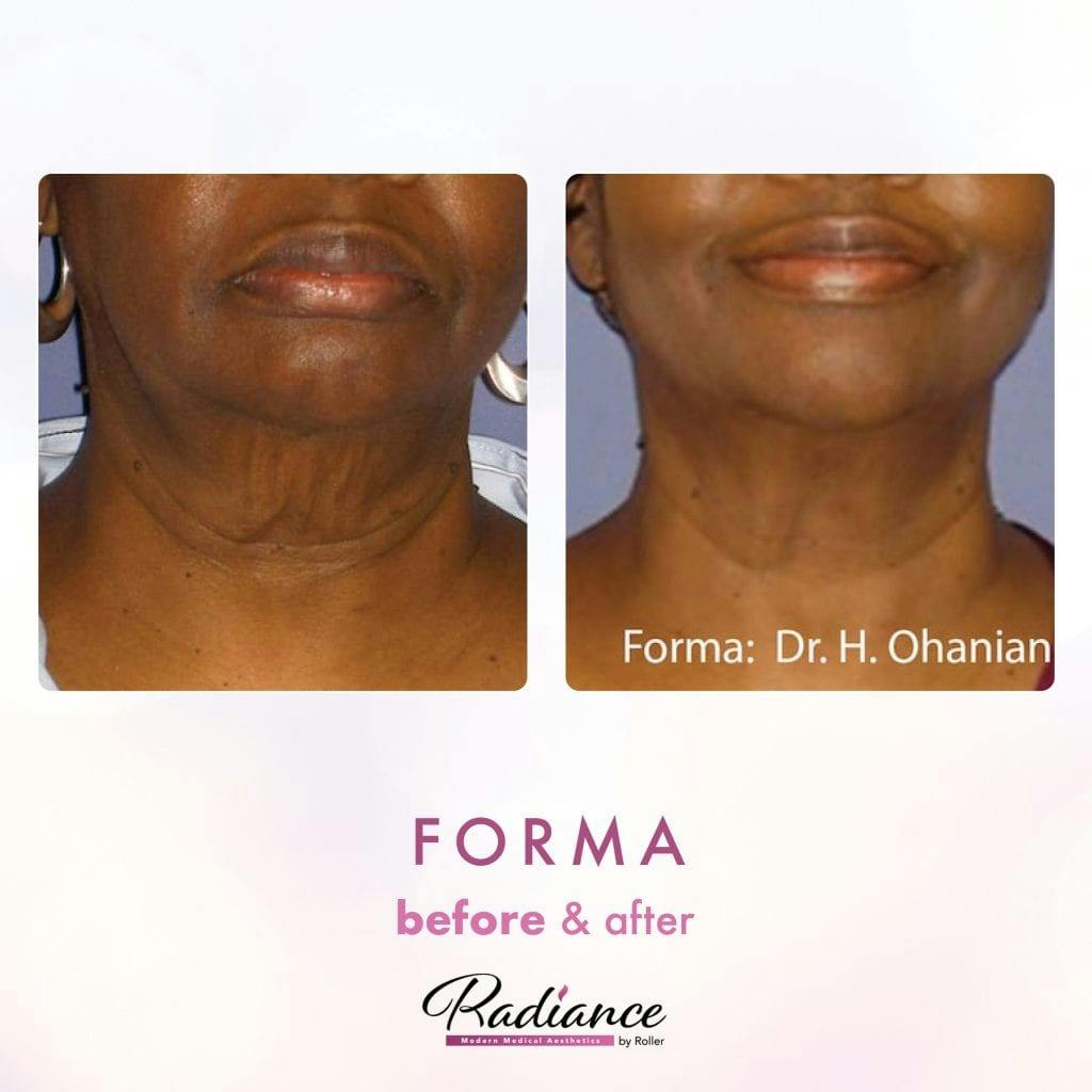 Forma Before & After Gallery - Patient 86641254 - Image 1