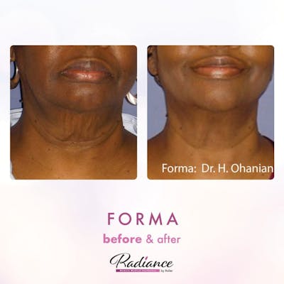 Forma Before & After Gallery - Patient 86641254 - Image 1