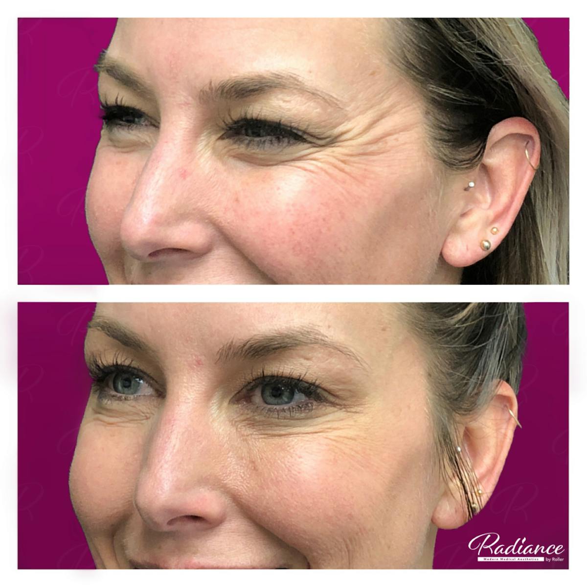 BOTOX Cosmetic Before & After Gallery - Patient 86641249 - Image 3