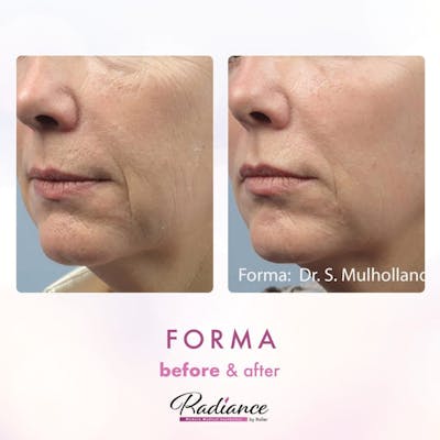 Forma Before & After Gallery - Patient 86641255 - Image 1