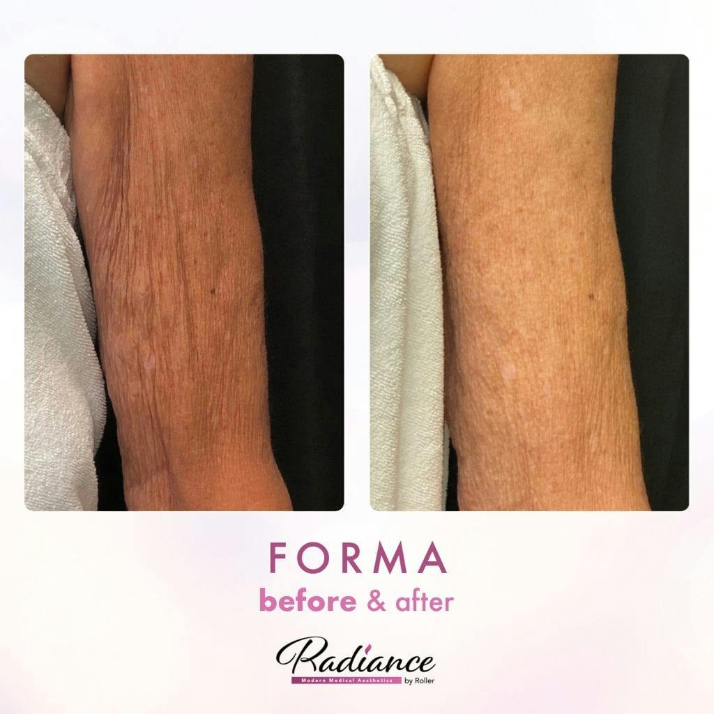 Forma Before & After Gallery - Patient 86641263 - Image 1