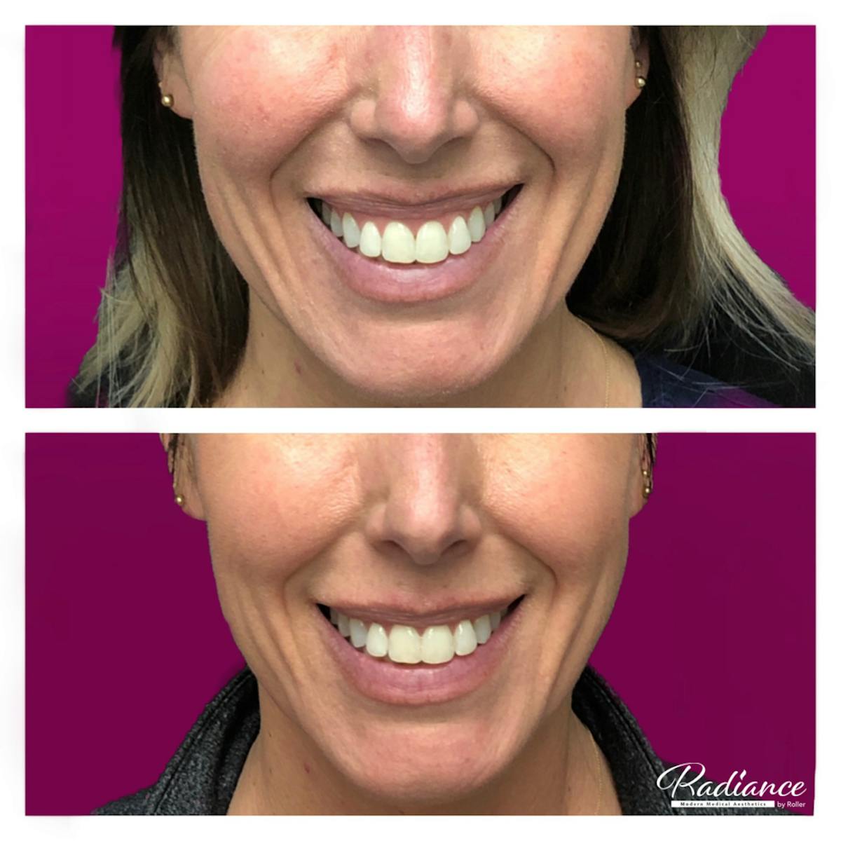 BOTOX Cosmetic Before & After Gallery - Patient 86641266 - Image 1