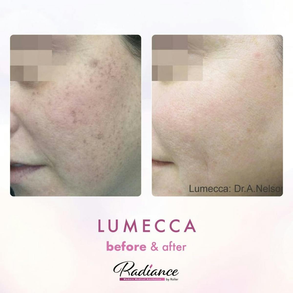 Lumecca Before & After Gallery - Patient 86641264 - Image 1