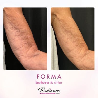 Forma Before & After Gallery - Patient 86641265 - Image 1