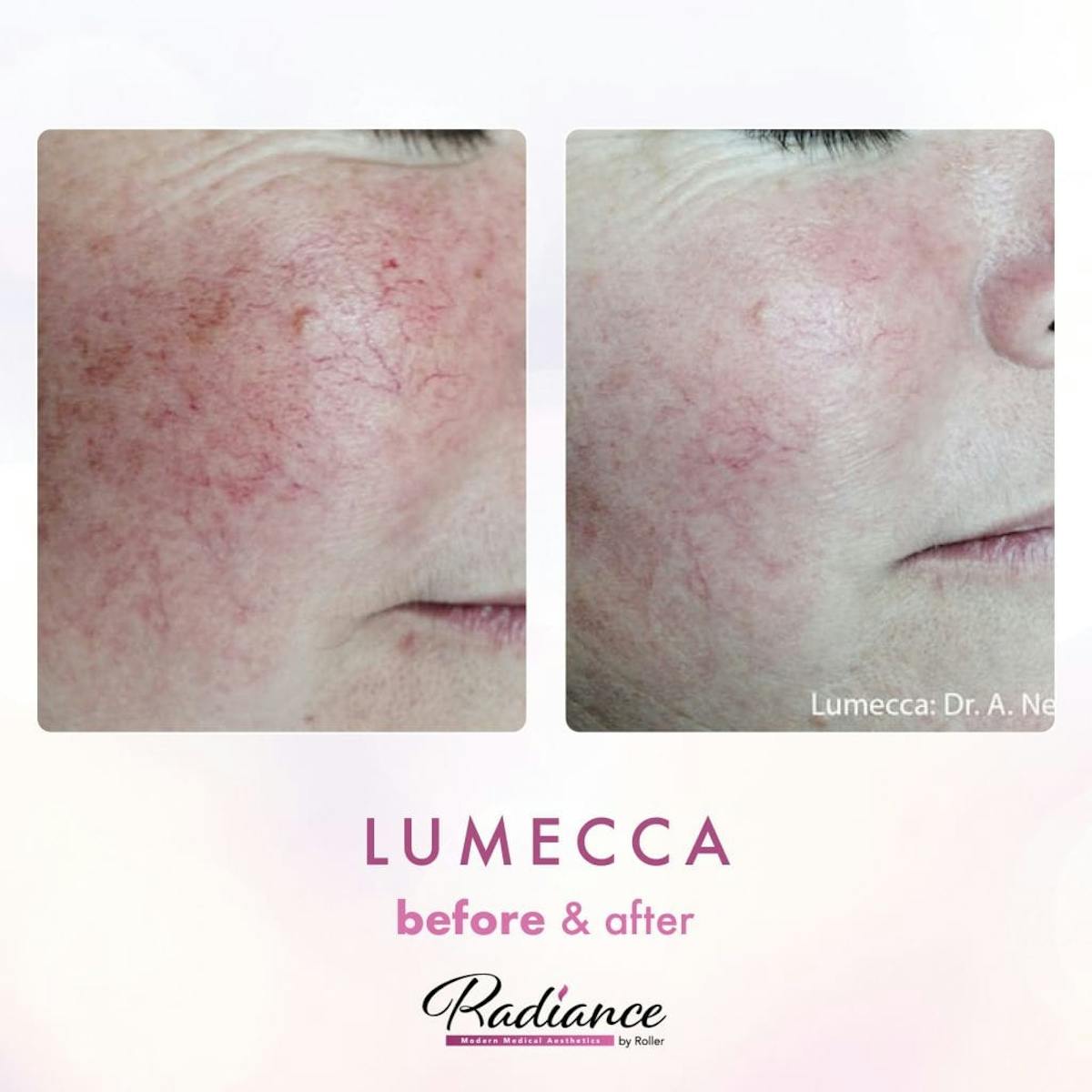 Lumecca Before & After Gallery - Patient 86641267 - Image 1