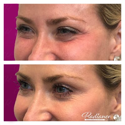 BOTOX Cosmetic Before & After Gallery - Patient 86641270 - Image 1