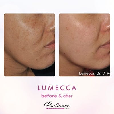 Lumecca Before & After Gallery - Patient 86641269 - Image 1