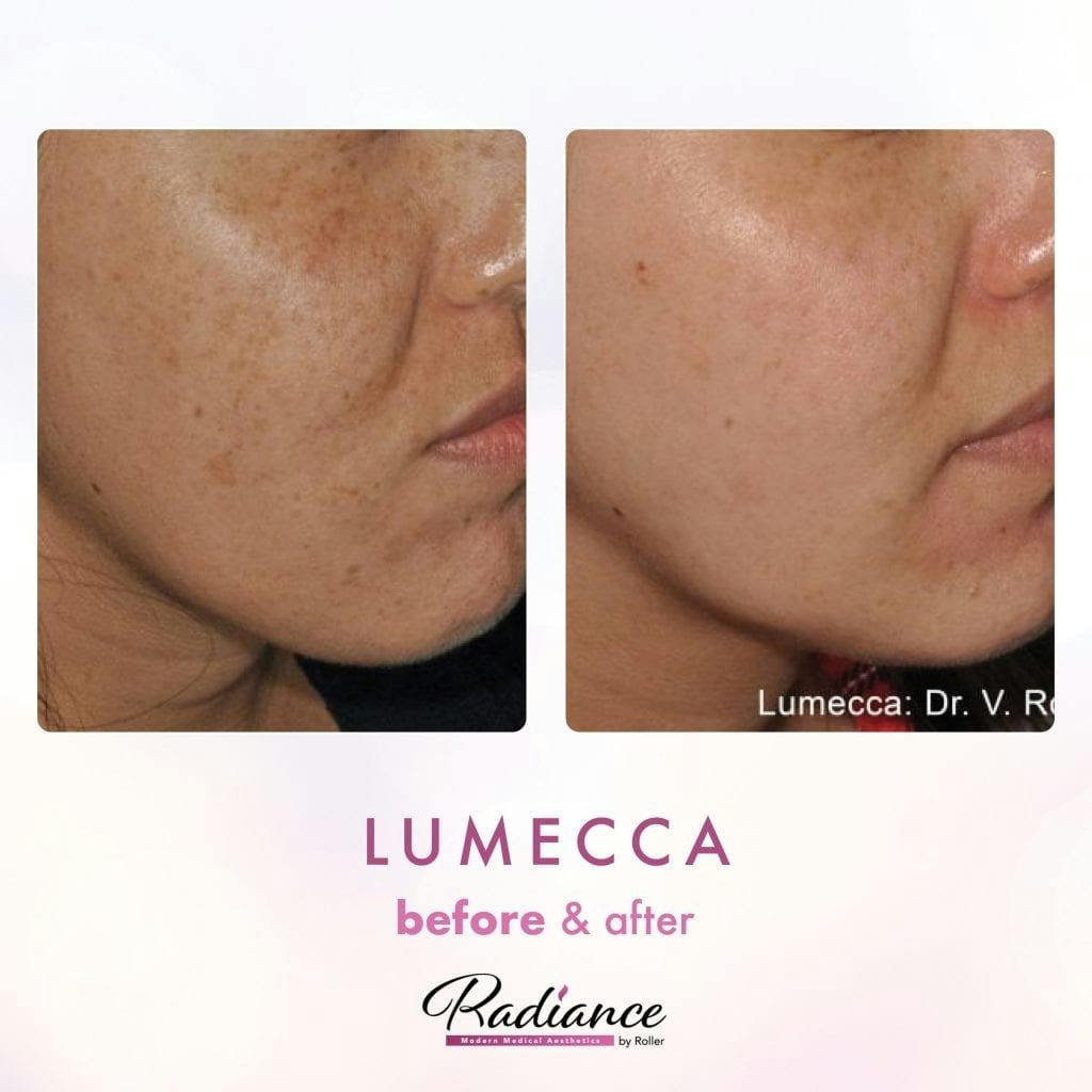 Lumecca Before & After Gallery - Patient 86641269 - Image 1