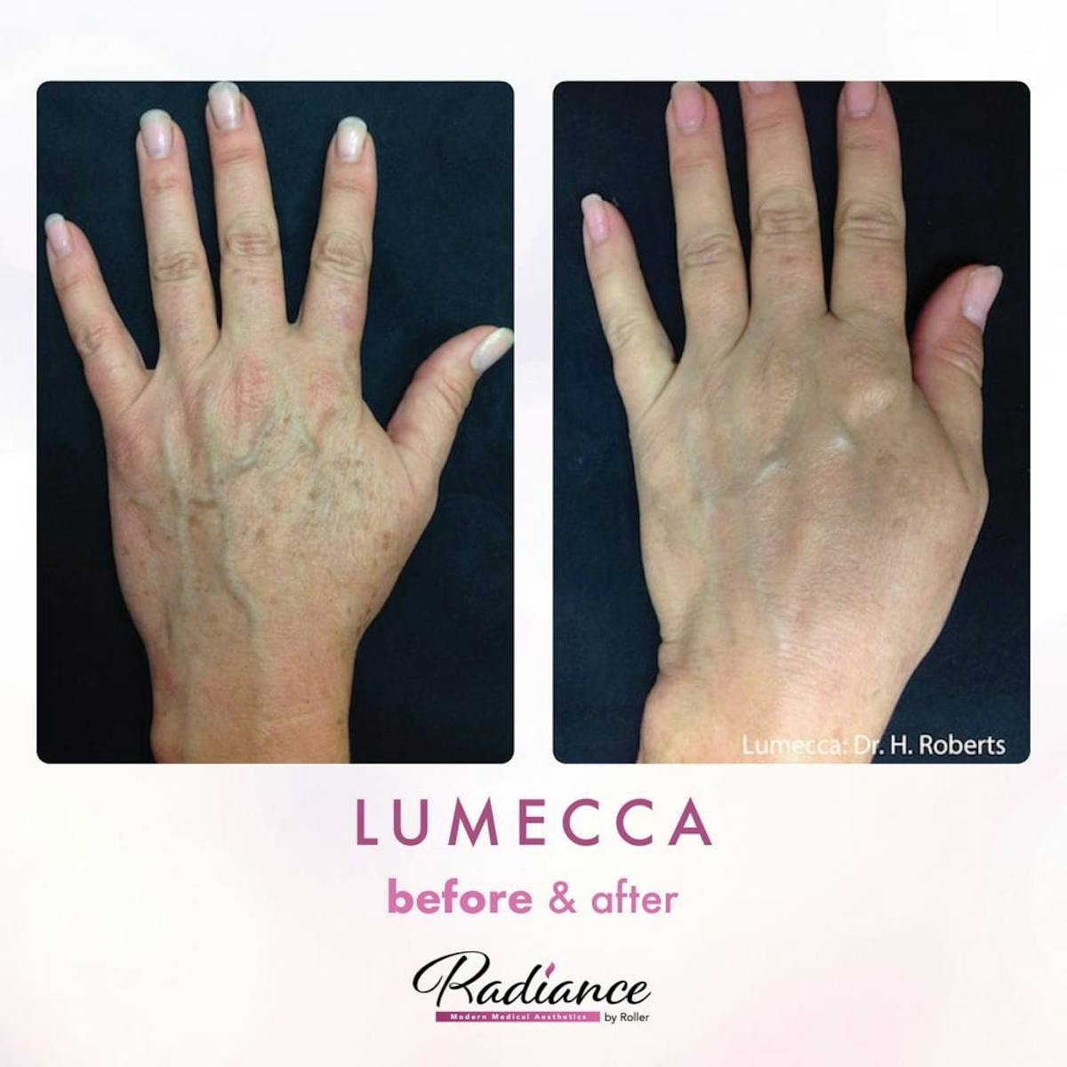 Lumecca Before & After Gallery - Patient 86641271 - Image 1