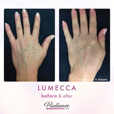 Lumecca Before & After Gallery - Patient 86641271 - Image 1