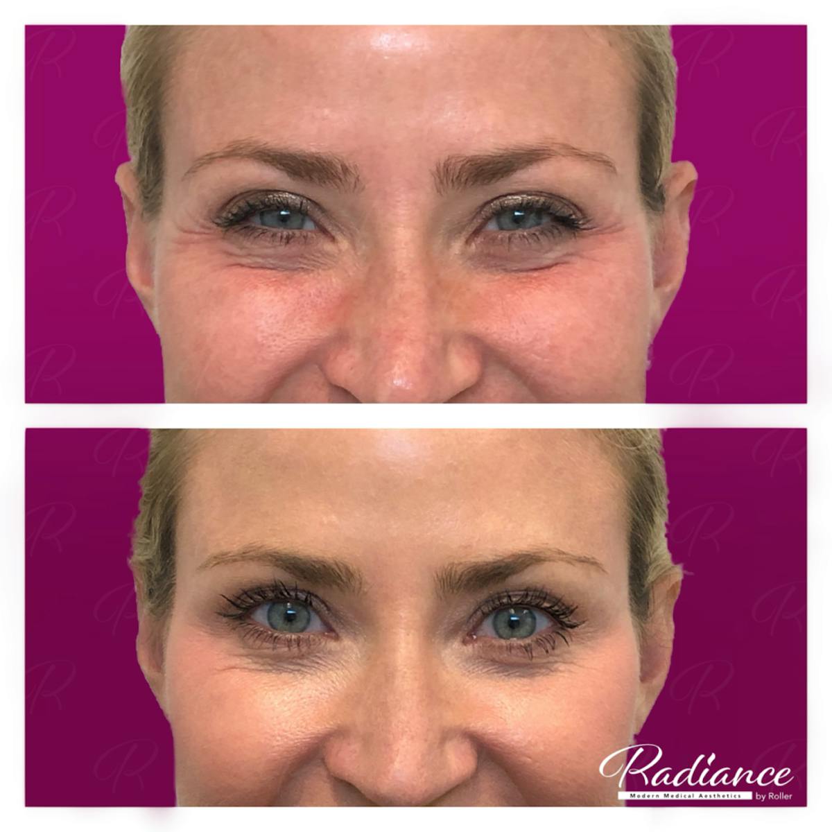 BOTOX Cosmetic Before & After Gallery - Patient 86641270 - Image 2