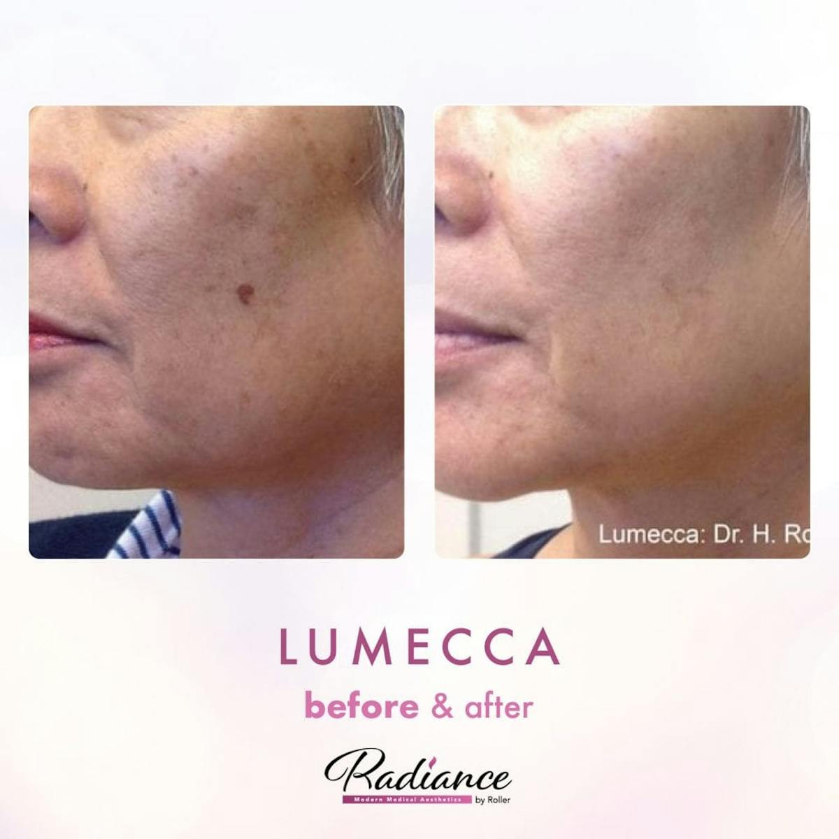 Lumecca Before & After Gallery - Patient 86641272 - Image 1