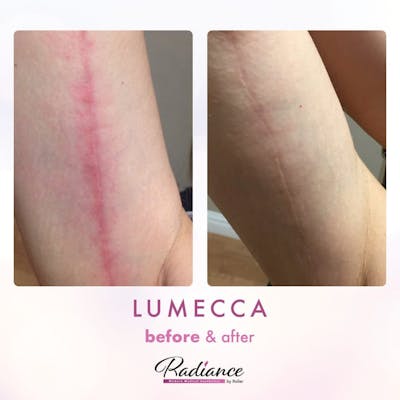Lumecca Before & After Gallery - Patient 86641275 - Image 1
