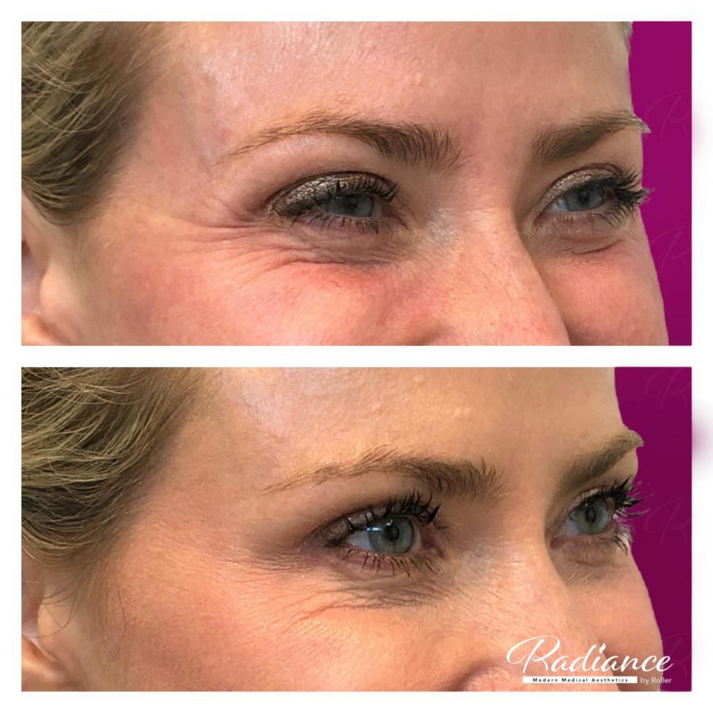 BOTOX Cosmetic Before & After Gallery - Patient 86641270 - Image 3