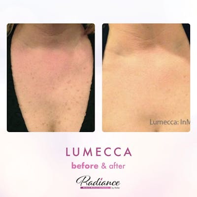 Lumecca Before & After Gallery - Patient 86641278 - Image 1