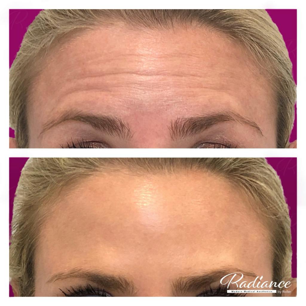 BOTOX Cosmetic Before & After Gallery - Patient 86641270 - Image 4