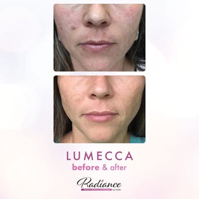 Lumecca Before & After Gallery - Patient 86641280 - Image 1