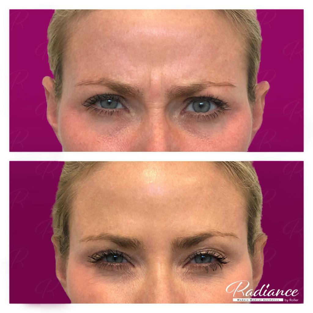 BOTOX Cosmetic Before & After Gallery - Patient 86641270 - Image 5