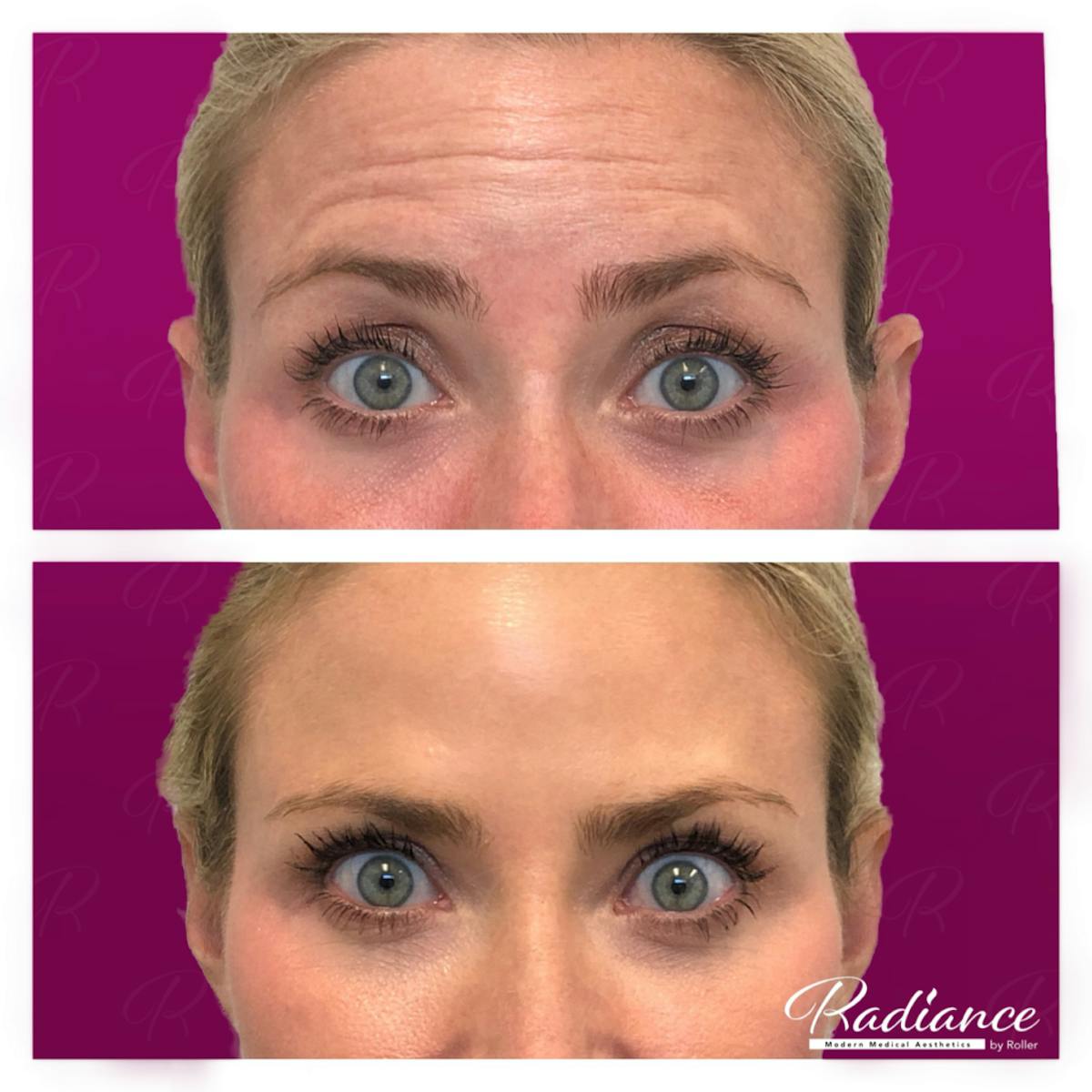 BOTOX Cosmetic Before & After Gallery - Patient 86641270 - Image 6